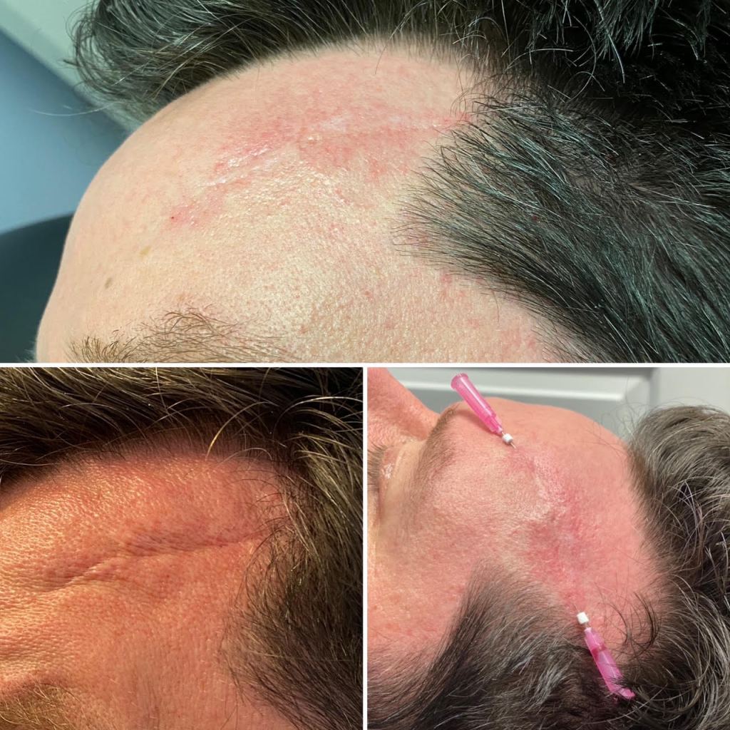 scar treatment before and after using PDO smooth threads in Milford CT
