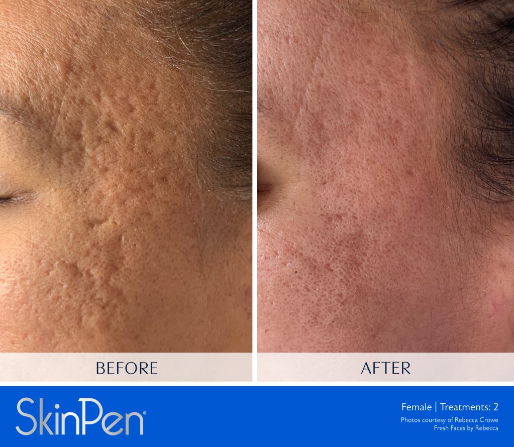 SkinPen microneedling before and after acne scar healing to face in Milford CT