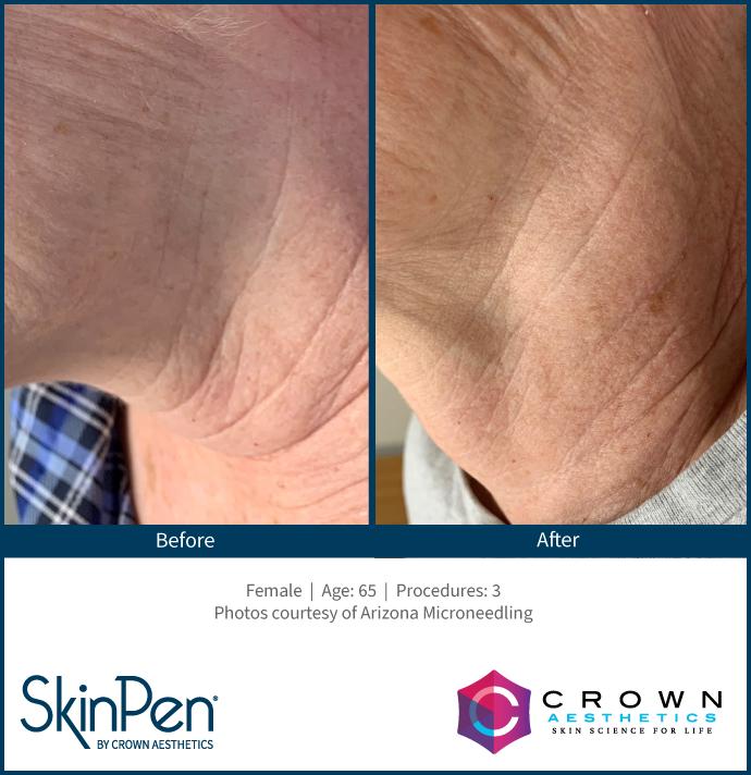Neck wrinkles improvement before and after skinpen microneedling in Milford, CT
