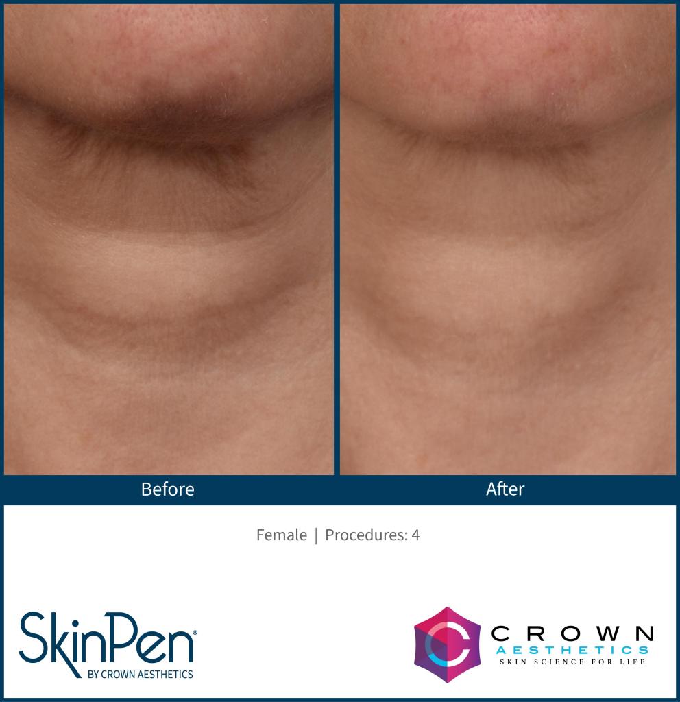 Neck wrinkles improvement before and after skinpen microneedling at Milford Med Spa